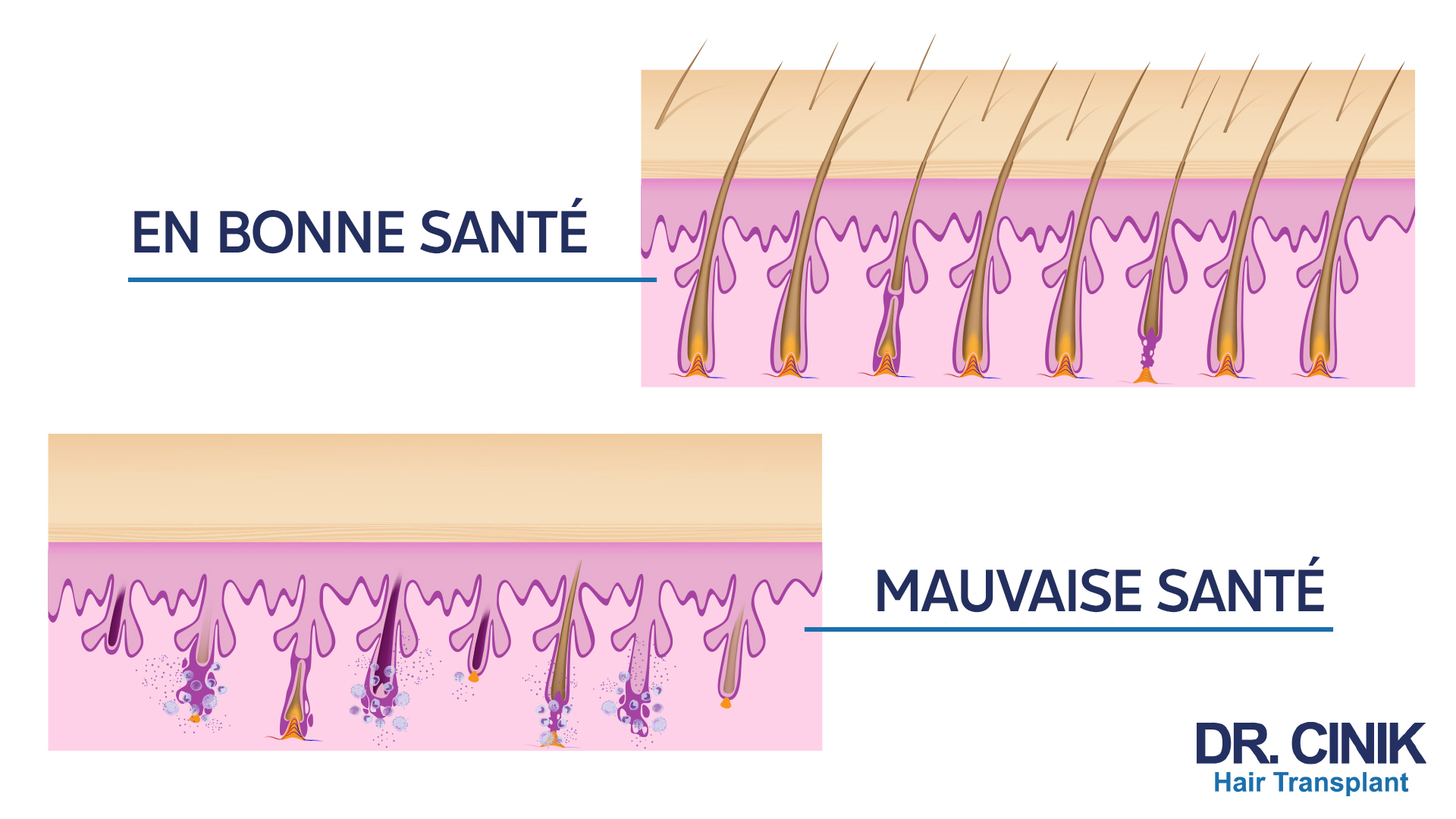 Follicules pileux en bonne santé vs follicules pileux en mauvaise santé