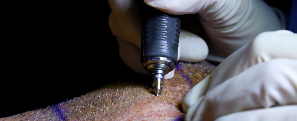 Dr Cinik using a micropunch to extract hair using FUE technique