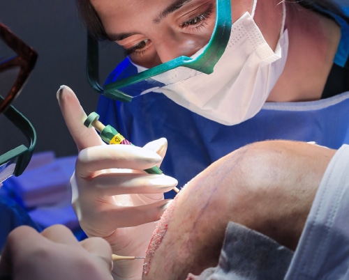 A hair surgeon using a CHOI implanter pen