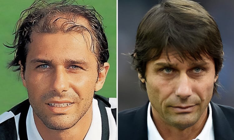 Antonio Conte Hair Transplant