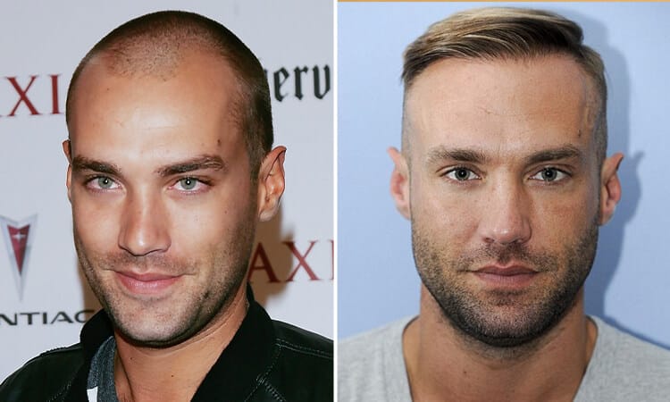 Calum Best Hair Transplant