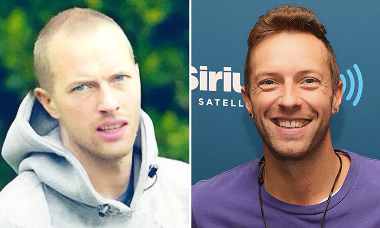 Chris Martin Coldplay Hair Transplant