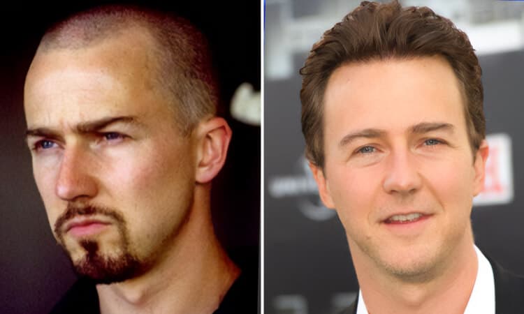 Edward Norton Hair Transplant