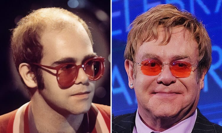 Elton John Hair Transplant