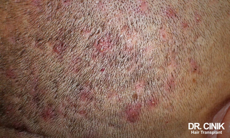 Eosinophilic Folliculitis