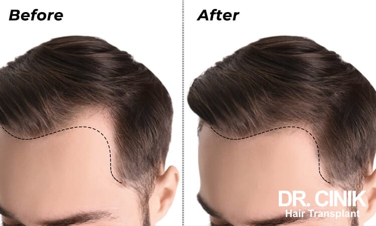 natural hairline is a success factor of a hair implant