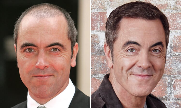 James Nesbitt Hair Transplant