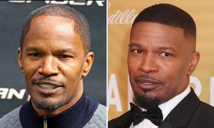 Jamie Foxx Hair Transplant