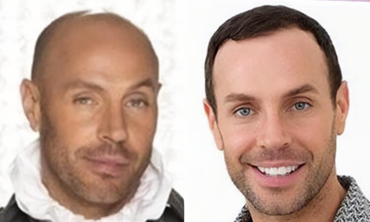 Jason Gardiner Hair Transplant