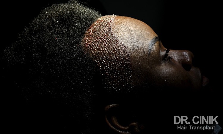 A young woman with afro hair after a hair transplant