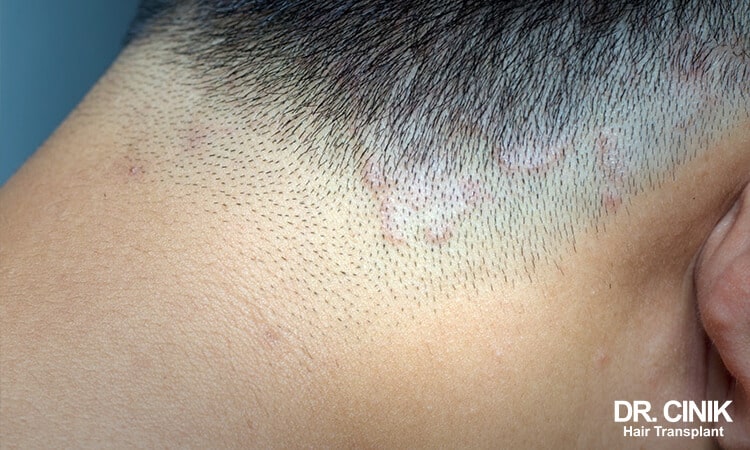 Ring worm on scalp