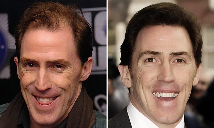 Rob Brydon Hair Transplant