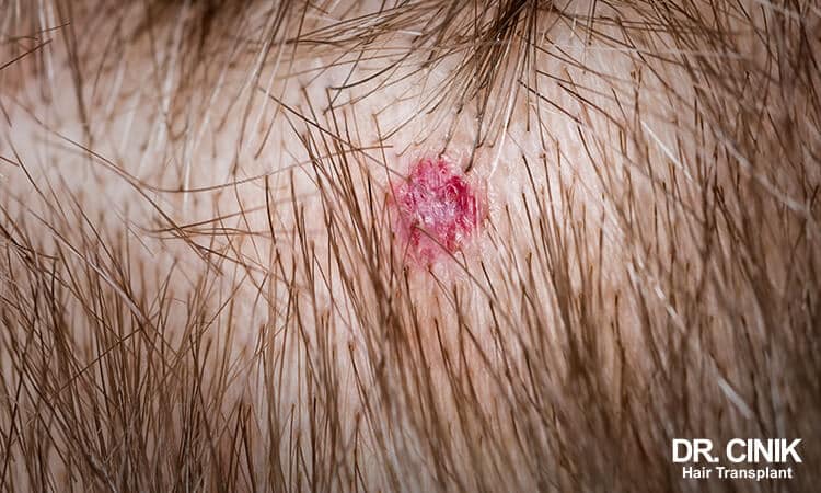 Skin Cancer on the Scalp