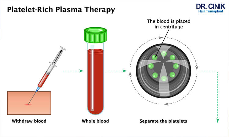 PRP treatment step 1