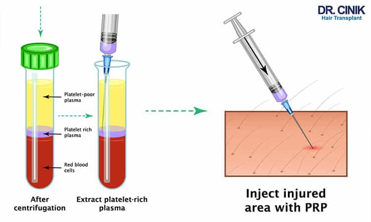 PRP hair treatment step 2