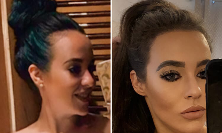 Stephanie Davis Hair Transplant