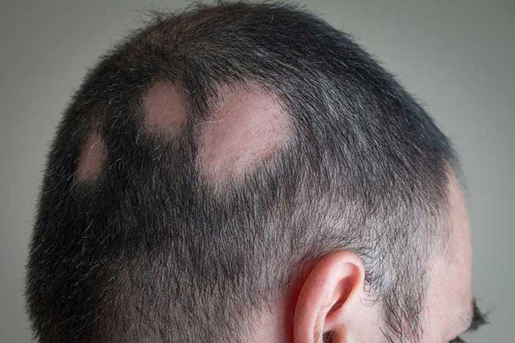 alopecia areata