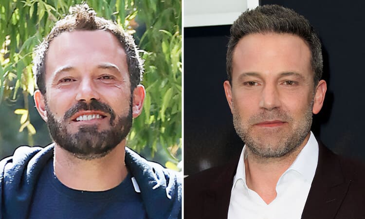 Ben Affleck Hair Transplant