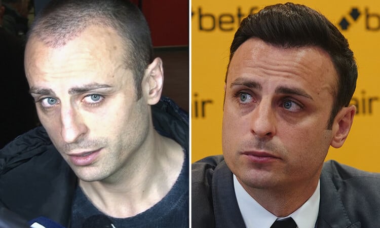 Dimitar Berbatov Hair Transplant