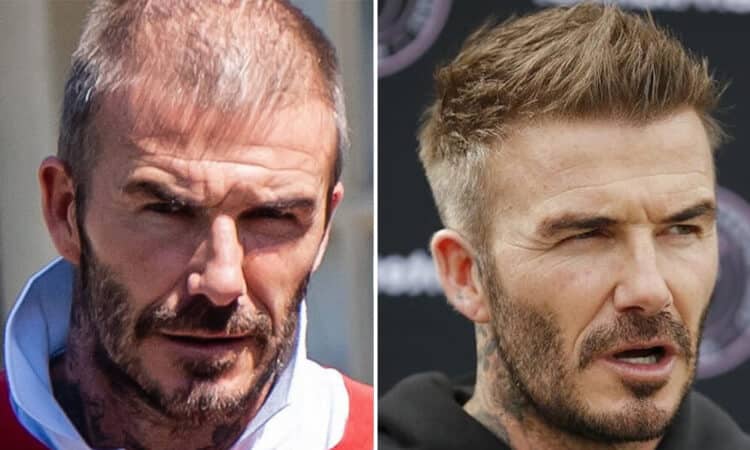 David Beckham Hair Transplant