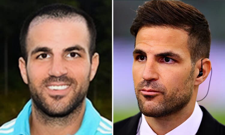 Cesc Fabregas Hair Transplant