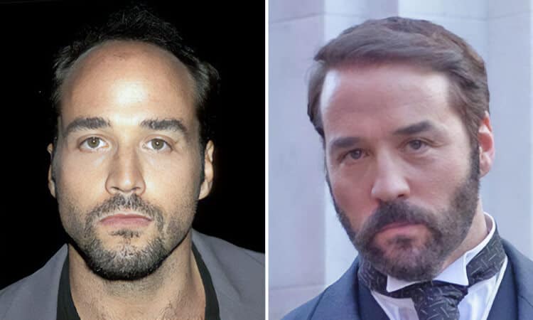 Jeremy Piven Hair Transplant