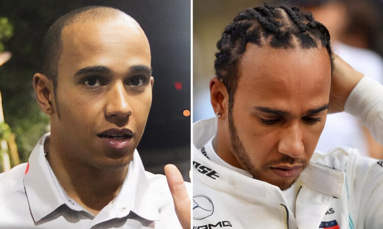 Lewis Hamilton Hair Transplant