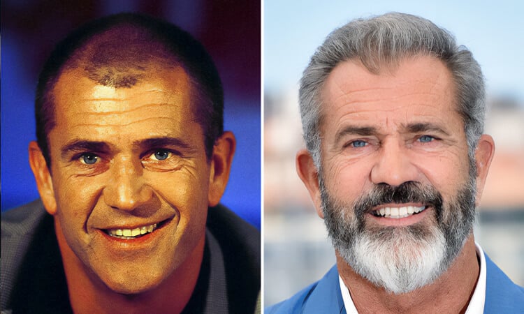 Mel Gibson Hair Transplant