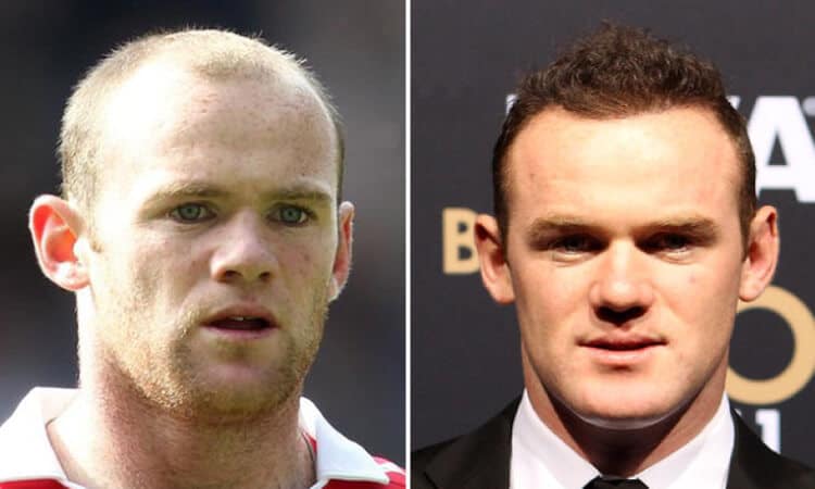 Wayne Rooney Hair Transplant