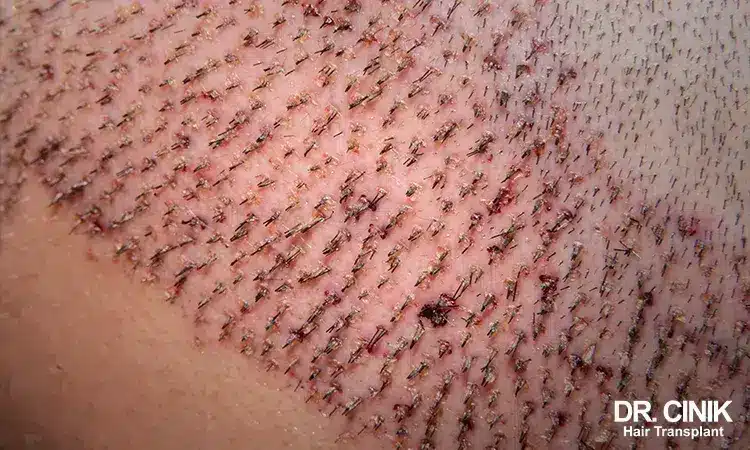 Scabs on the scalp