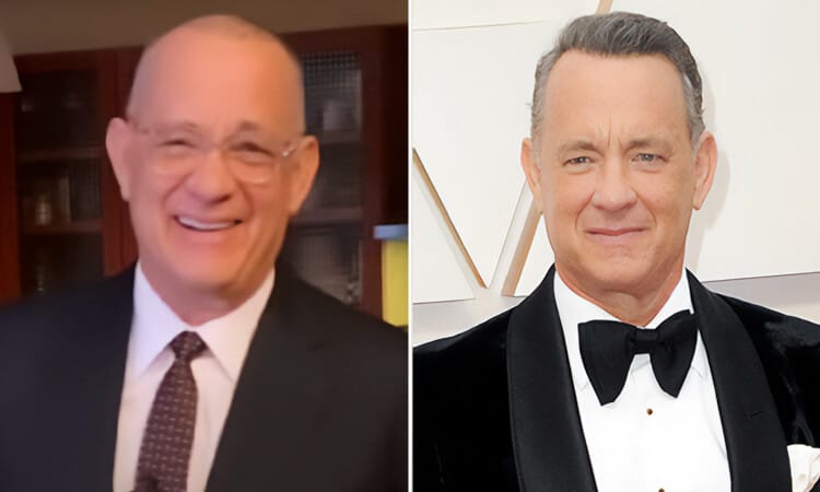 Tom Hanks Hair Transplant