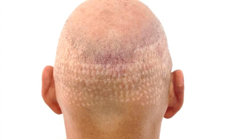 Unhealthy donor area after a failed hair transplant