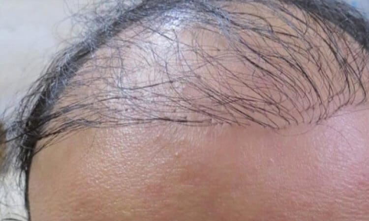 hair transplant risks - hair transplant gone wrong for a man