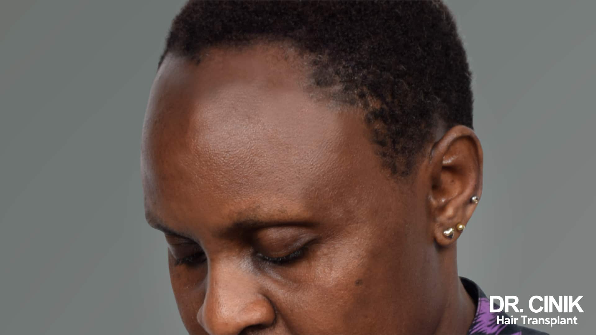 Traction Alopecia, a type of patchy hair loss