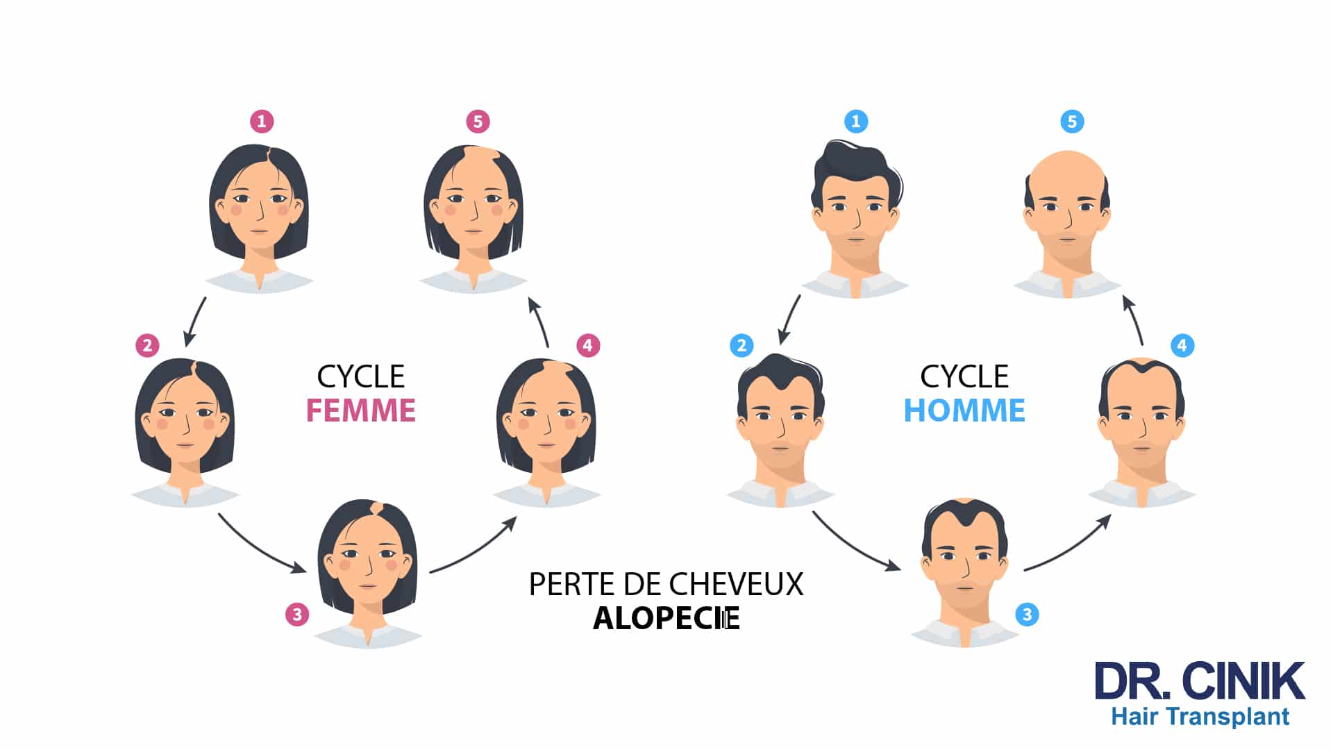 Illustration de l'évolution de l'alopécie androgénétique chez l'homme et chez la femme