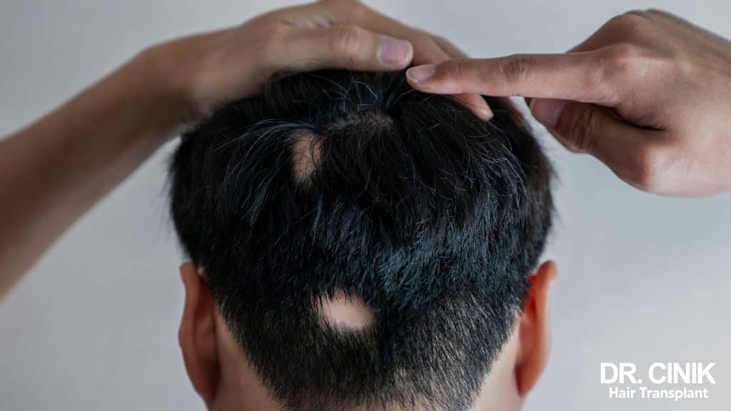 A instance of alopecia areata