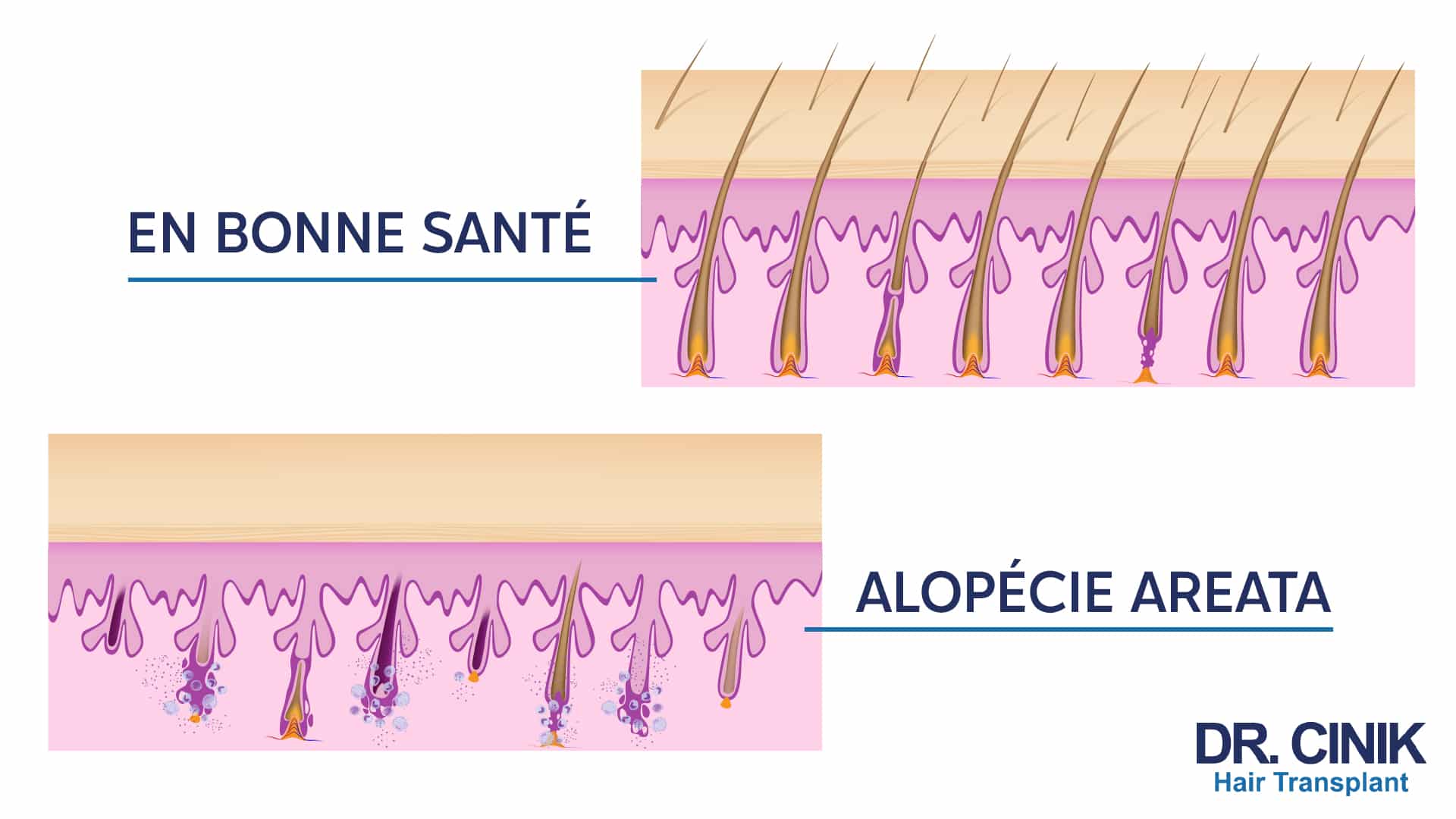 Schéma comparatif : en haut des cheveux en bonne santé, en bas des cheveux avec une pelade