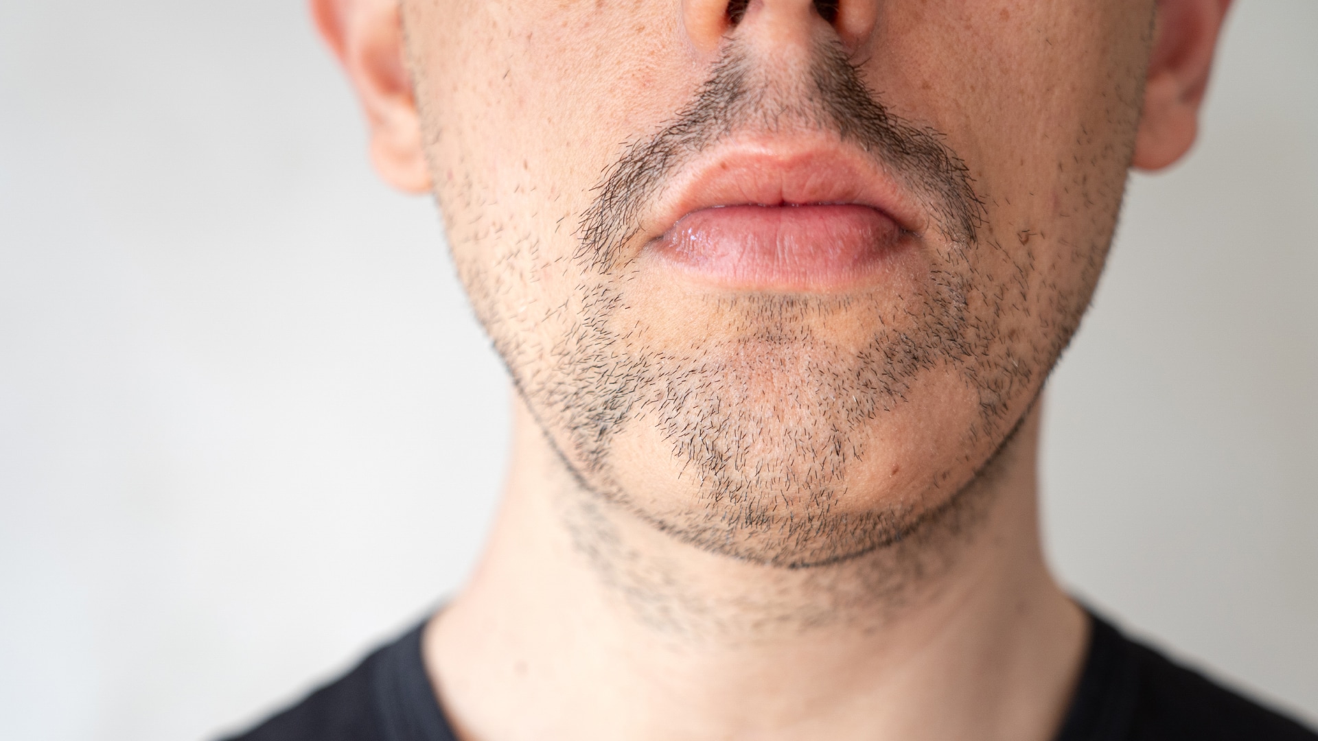 Alopecia Areata in beard