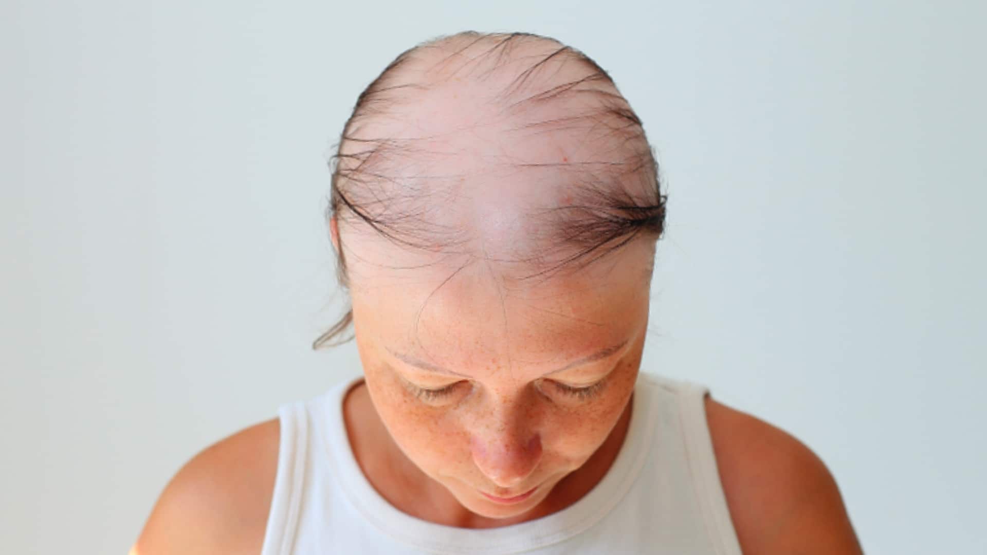 Alopecia Totalis