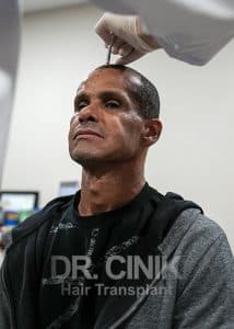 Rivaldo avant sa greffe de cheveux en Turquie