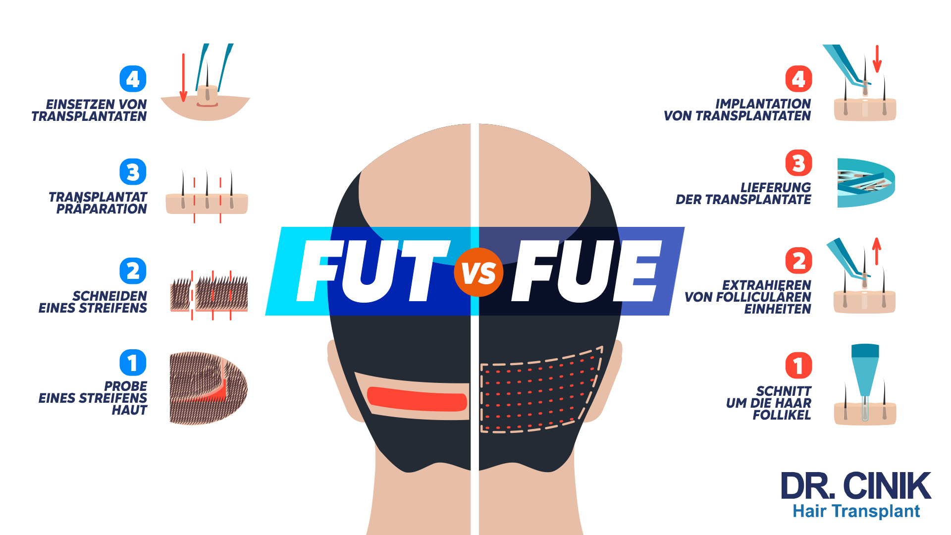 Die Grafik zeigt einen Vergleich zwischen zwei Haartransplantationsmethoden: "FUT" und "FUE". In der Mitte ist ein schematischer Kopf abgebildet, der zur Hälfte mit "FUT" und zur anderen Hälfte mit "FUE" beschriftet ist. Auf der "FUT"-Seite beginnt die Prozedur mit Schritt 1, bei dem ein "Probe eines Streifens Haut" gezeigt wird. Schritt 2 zeigt das "Schneiden eines Streifens" Haut. In Schritt 3 wird die "Transplantat Präparation" dargestellt, und Schritt 4 zeigt das "Einsetzen von Transplantaten" in die Kopfhaut. Auf der "FUE"-Seite zeigt Schritt 1 den "Schnitt um die Haar Follikel". In Schritt 2 wird das "Extrahieren von follicularen Einheiten" dargestellt. Schritt 3 zeigt die "Lieferung der Transplantate", und Schritt 4 zeigt die "Implantation von Transplantaten" in die Kopfhaut. Unten rechts ist das Logo "DR. CINIK Hair Transplant" zu sehen.