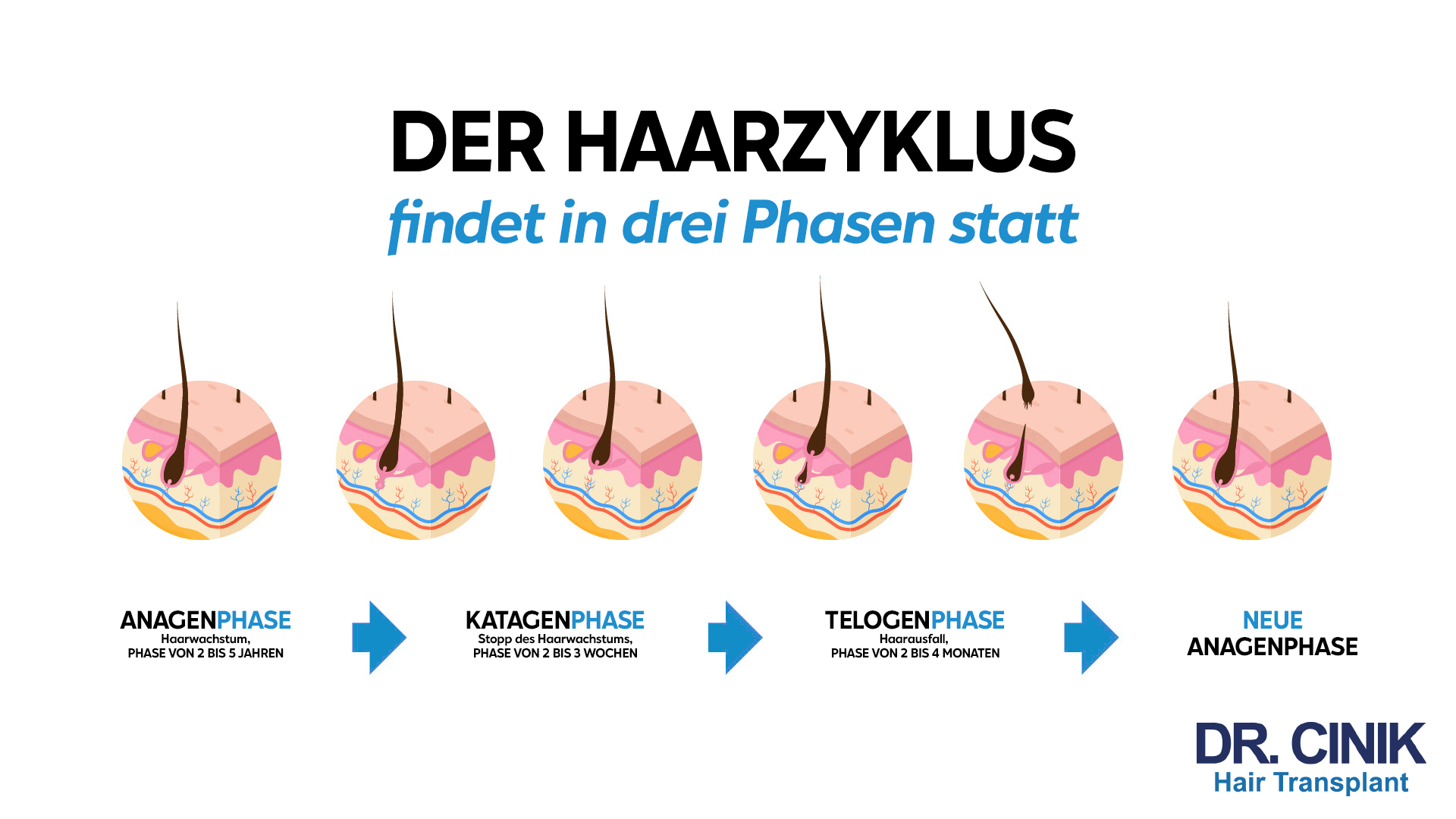 Grafik mit dem Titel "DER HAARZYKLUS findet in drei Phasen statt". Es werden vier kreisförmige Illustrationen gezeigt, die die Stadien des Haarzyklus darstellen. Die erste Phase, "ANAGENPHASE", zeigt das Haarwachstum und dauert von 2 bis 5 Jahren. Es folgt die "KATAGENPHASE", in der das Haarwachstum stoppt und die zwischen 2 bis 3 Wochen dauert. Anschließend wird die "TELOGENPHASE" dargestellt, in der Haarausfall auftritt und die von 2 bis 4 Monaten dauert. Zum Schluss zeigt die Grafik eine "NEUE ANAGENPHASE". Unten rechts ist das Logo "DR. CINIK Hair Transplant" zu sehen.