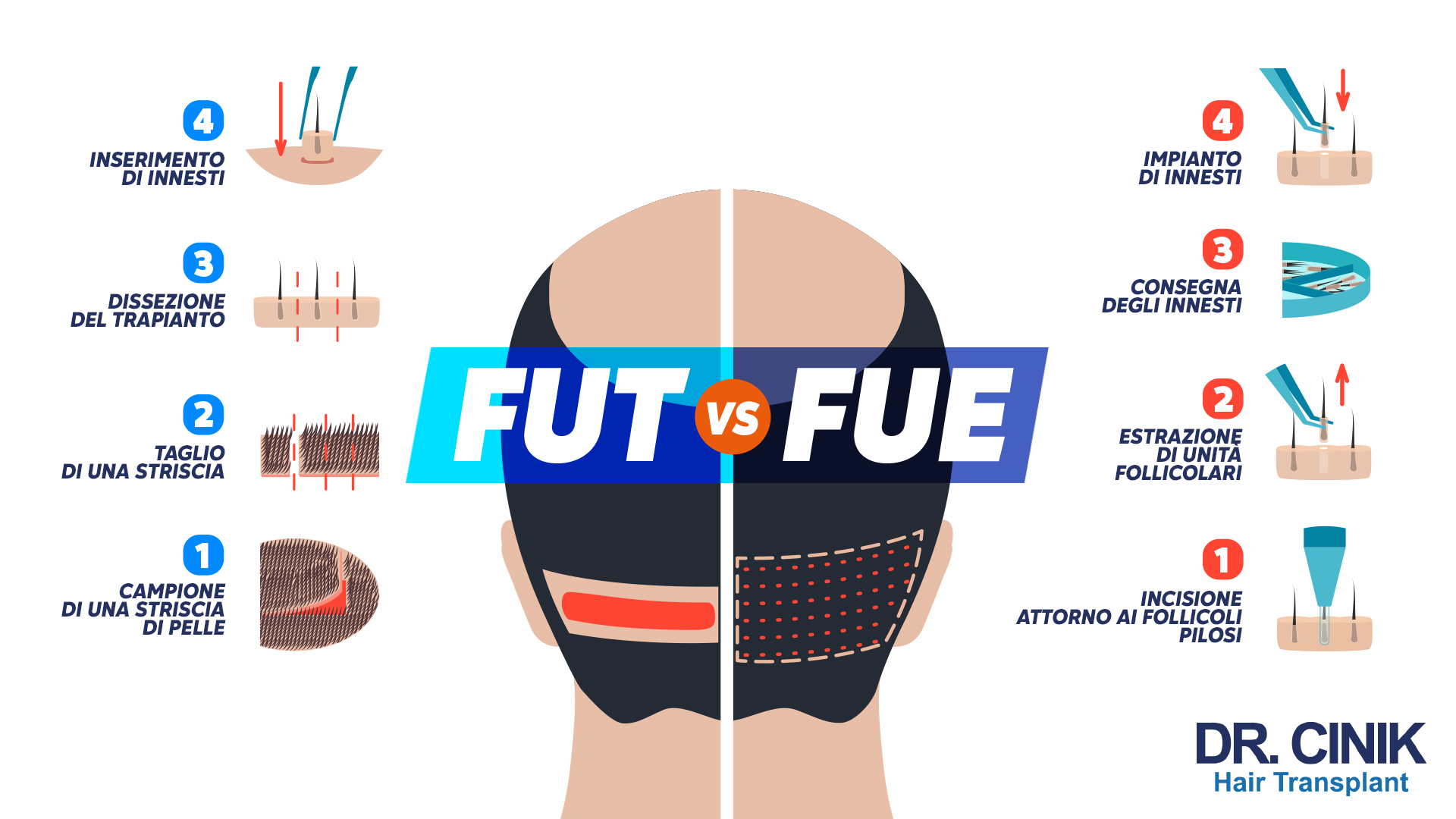 L'immagine confronta due tecniche di trapianto dei capelli, la FUT e la FUE, che sono rappresentate su ciascun lato della testa disegnata al centro. La parte sinistra dell'immagine mostra le fasi del metodo FUT, che include il prelievo di una striscia di cuoio capelluto e la successiva dissezione e inserimento degli innesti. Sul lato destro, viene illustrato il processo FUE, dove i follicoli vengono estratti uno per uno e poi impiantati. Queste procedure sono rappresentate attraverso illustrazioni schematiche che evidenziano la diversa metodologia di prelievo e inserimento dei follicoli capillari.