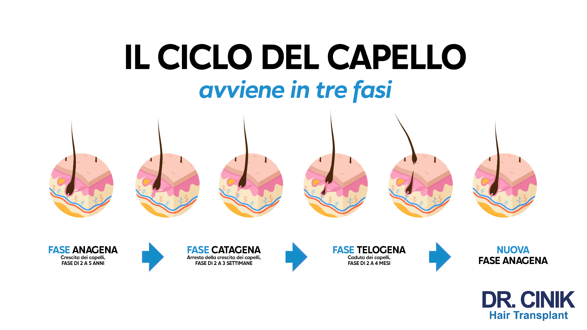 Descrizione dell'immagine: Il grafico presenta il ciclo di vita del capello suddiviso in quattro fasi principali. In alto si legge "IL CICLO DEL CAPELLO avviene in tre fasi". Le prime tre vignette mostrano la progressione del ciclo del capello da una fase attiva di crescita a una di cessazione e infine a una di caduta. La prima vignetta è etichettata "FASE ANAGENA" che indica la crescita dei capelli durata da 2 a 5 anni. La seconda vignetta è "FASE CATAGENA", una transizione breve di 2 a 3 settimane dove la crescita dei capelli si ferma. La terza vignetta è "FASE TELOGENA", che dura da 2 a 4 mesi, e rappresenta la caduta dei capelli. L'ultima vignetta rappresenta la "NUOVA FASE ANAGENA" dove inizia una nuova crescita di capelli. In basso a destra compare il logo "DR. CINIK Hair Transplant".