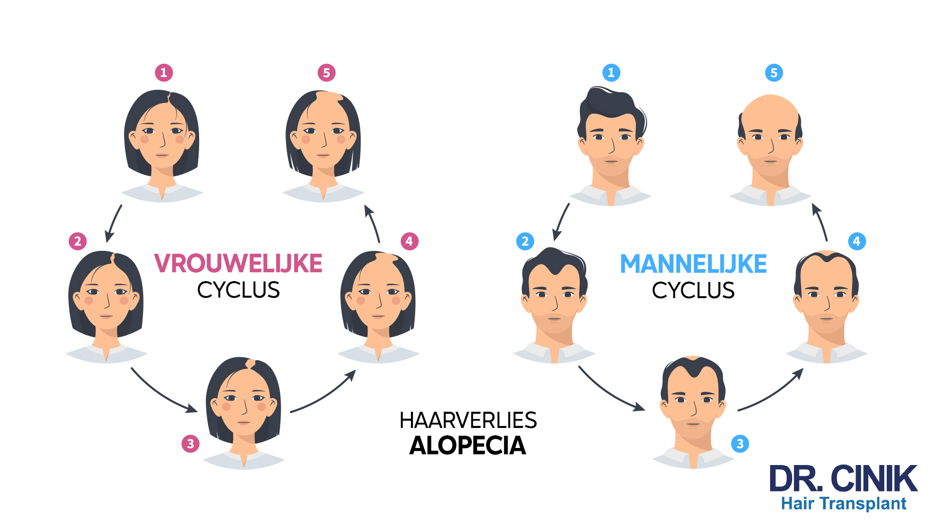 Een educatieve grafiek die de progressie van haarverlies bij mannen en vrouwen illustreert, gelabeld in het Nederlands. Aan de linkerkant wordt 'VROUWELIJKE CYCLUS' getoond met nummers 1 tot 5 die verschillende stadia van haarverdunning op het hoofd aanduiden. De rechterkant toont 'MANNELIJKE CYCLUS' met een soortgelijke nummering die de ontwikkeling van mannelijke kaalheid weergeeft, beginnend met vol haar tot bijna volledige kaalheid bovenop. In het midden staat 'HAARVERLIES ALOPECIA' als een verbindend punt tussen de cycli. Onderaan de grafiek staat 'DR. CINK Hair Transplant'.