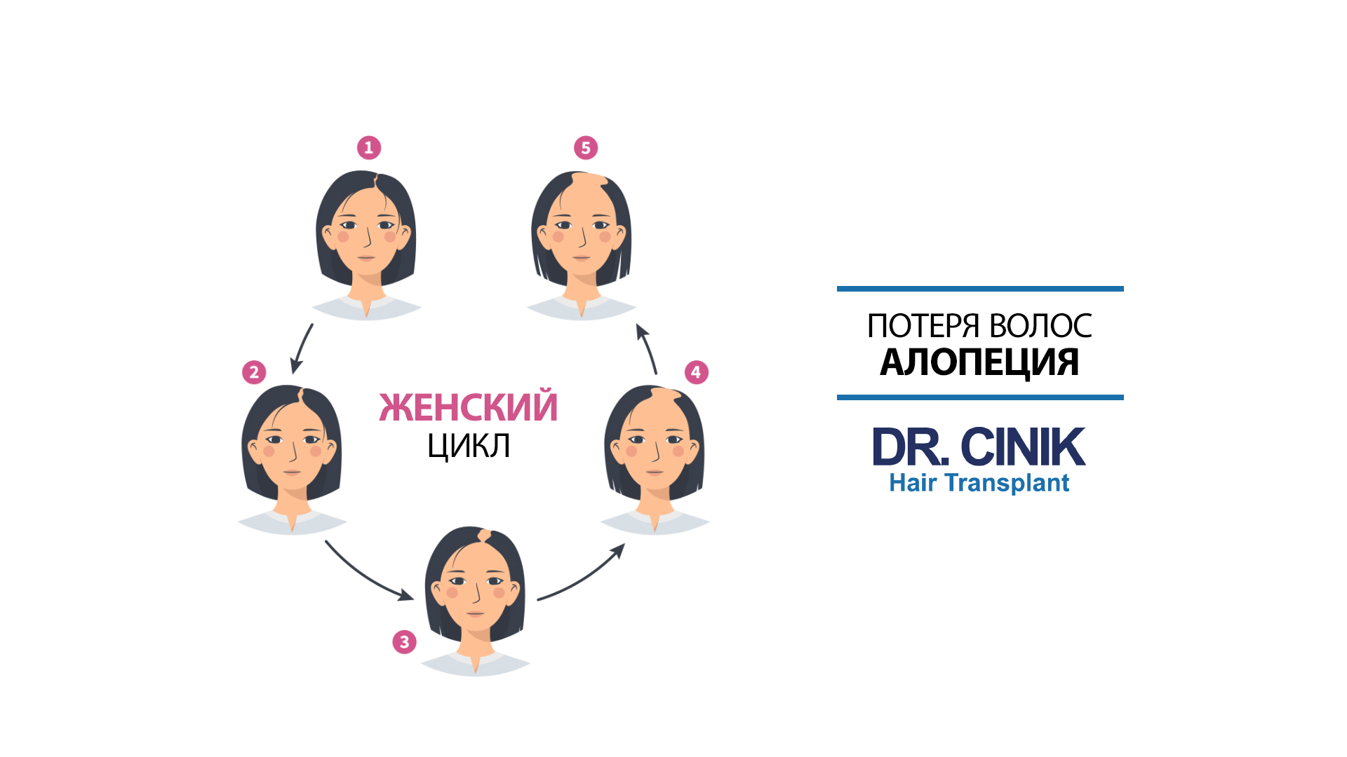 На изображении представлена схема, иллюстрирующая женский цикл алопеции, разделённая на пять стадий. Начиная с полной шевелюры, прогрессирующее истончение волос происходит по кругу от стадии 1 до стадии 5, где видны значительные потери волос. В правой части изображения размещены название состояния "потеря волос алопеция" и логотип клиники "DR. CINIK Hair Transplant" синего цвета. Элементы связаны стрелками, указывающими направление от одной стадии к другой, показывая прогрессирование алопеции.